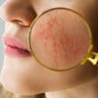 Rosacea Face Skin Problem And Aesthetic Treatment